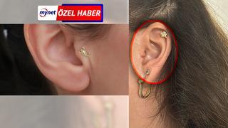 MYNET ÖZEL | Piercing kabusu: 8 yıl sonra kulağı ikiye ayrıldı! 