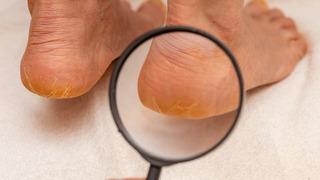 Ayakta nasır nasıl ve neden oluşur? Nasır neden çıkar?