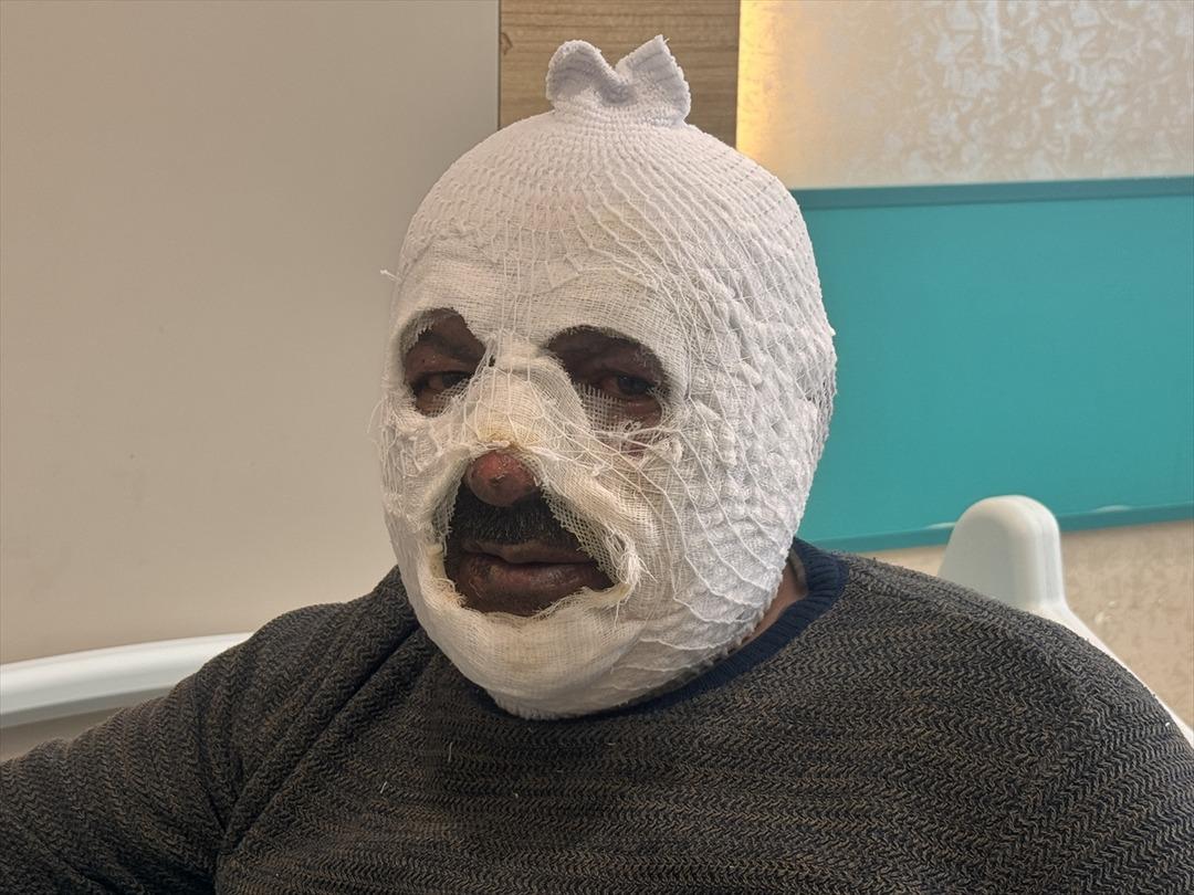 Facianın eşiğinden d&ouml;nd&uuml;! Kalorifer kazanını yakmak istedi, y&uuml;z&uuml;n&uuml; yaktı 1