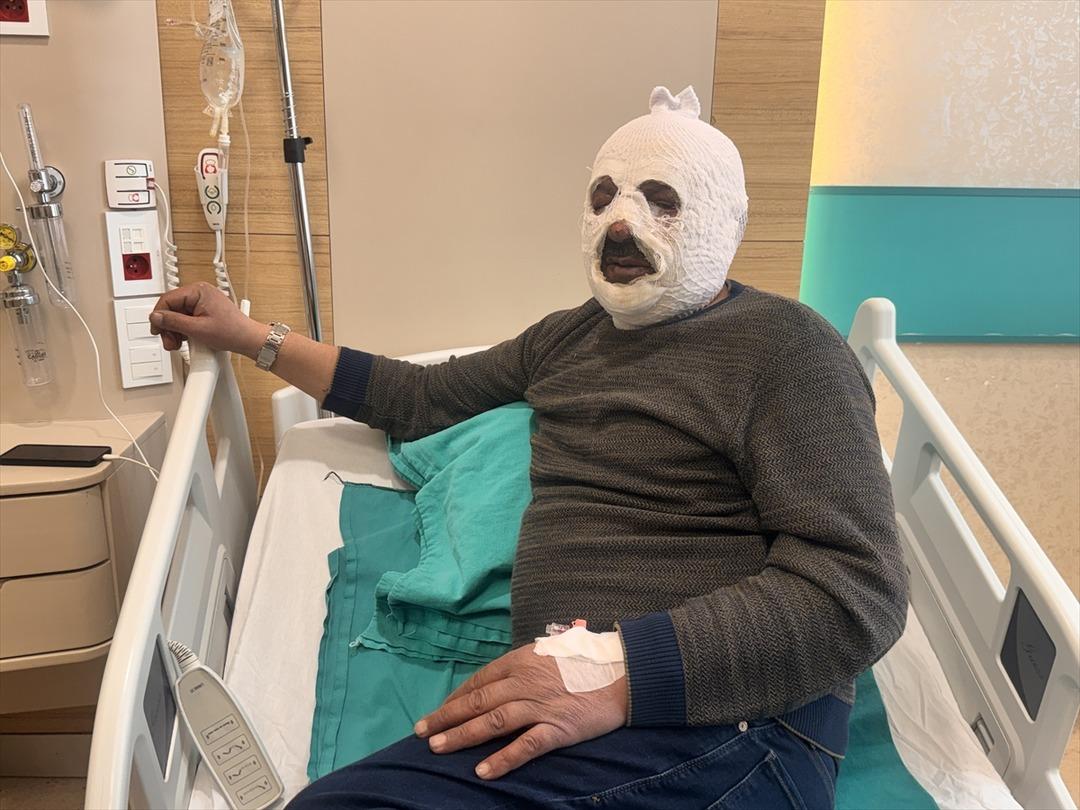 Facianın eşiğinden d&ouml;nd&uuml;! Kalorifer kazanını yakmak istedi, y&uuml;z&uuml;n&uuml; yaktı 2