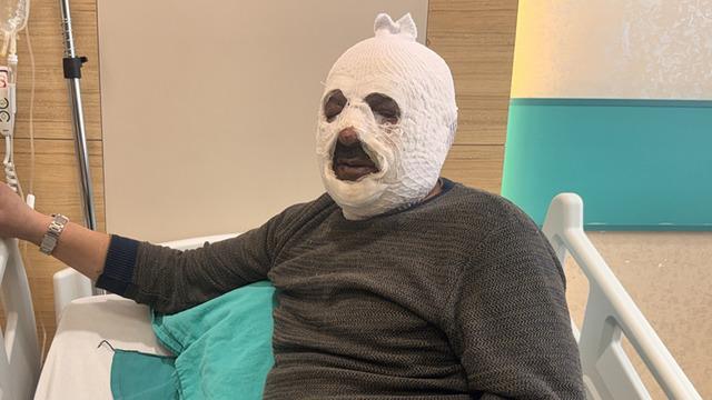 Facianın eşiğinden döndü! Kalorifer kazanını yakmak istedi, yüzünü yaktı