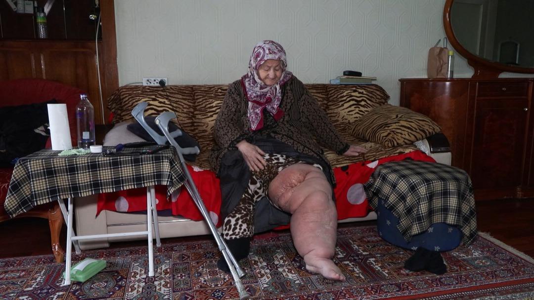 Adı: Fil hastalığı! Bacağı tanınmayacak halde ev aramak zorunda kaldı 3