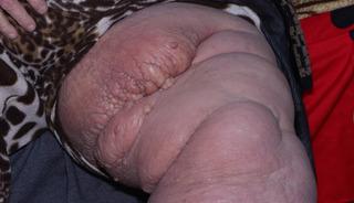 Adı: Fil hastalığı! Bacağı tanınmayacak hale geldi