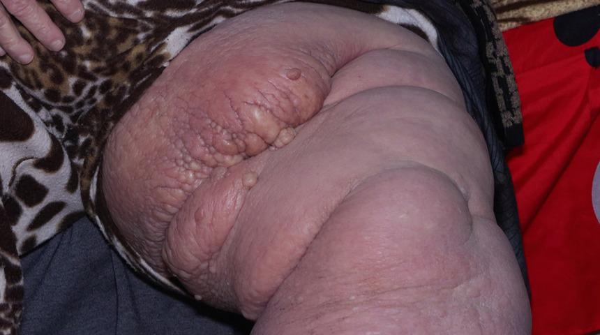 Adı: Fil hastalığı! Bacağı tanınmayacak halde ev aramak zorunda kaldı