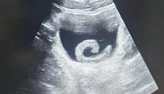 Tedavi olmak i&ccedil;in canlı s&uuml;l&uuml;ğ&uuml; mesanesine soktu! Doktorlar bile inanamadı