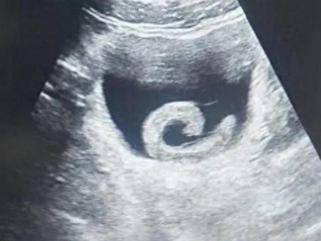 Tedavi olmak i&ccedil;in canlı s&uuml;l&uuml;ğ&uuml; mesanesine soktu!