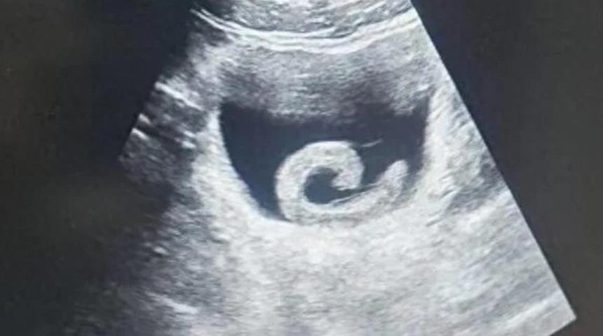 Tedavi olmak i&ccedil;in canlı s&uuml;l&uuml;ğ&uuml; mesanesine soktu! Doktorlar bile inanamadı