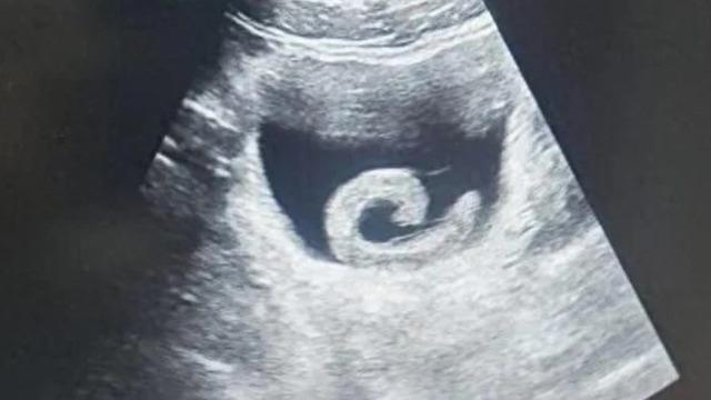 Tedavi olmak için canlı sülüğü mesanesine soktu! Doktorlar bile inanamadı