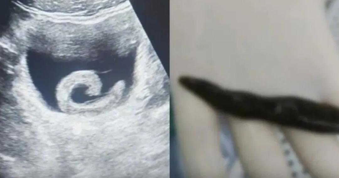 Tedavi olmak i&ccedil;in canlı s&uuml;l&uuml;ğ&uuml; mesanesine soktu! Doktorlar bile inanamadı 1