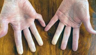 Renk değişiyorsa dikkat: Bu belirtiyi sakın hafife almayın