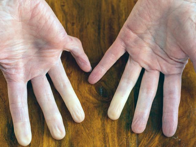 Renk değişiyorsa dikkat: Bu belirtiyi sakın hafife almayın