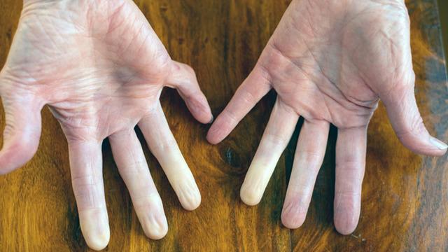 Gençleri daha çok etkiliyor: Vücutta mavi-mor renk alarmı! Raynaud fenomeni nedir?