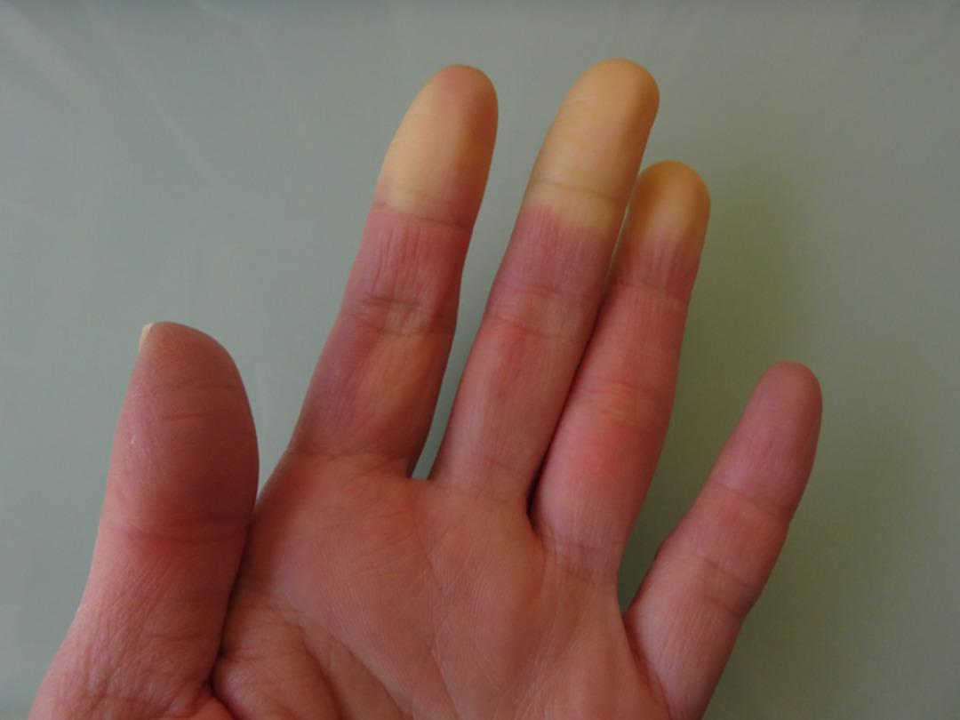 Gen&ccedil;leri daha &ccedil;ok etkiliyor: V&uuml;cutta mavi-mor renk alarmı! Raynaud fenomeni nedir? 2