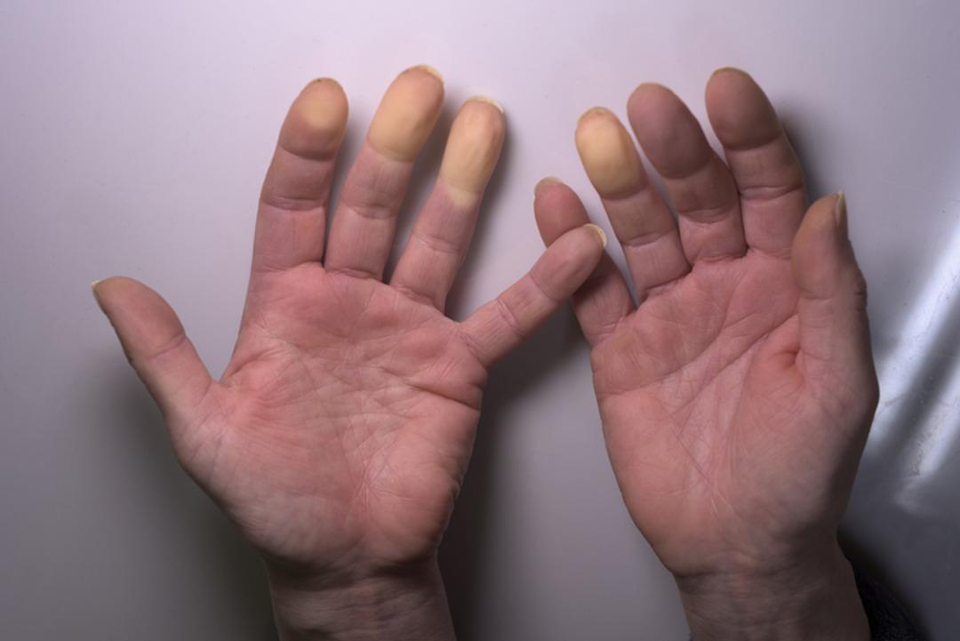 Gen&ccedil;leri daha &ccedil;ok etkiliyor: V&uuml;cutta mavi-mor renk alarmı! Raynaud fenomeni nedir? 3
