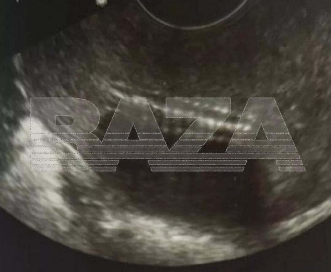 &Ouml;zel klinikte skandal ihmal! Doktor rahimde metal fır&ccedil;a unuttu 2