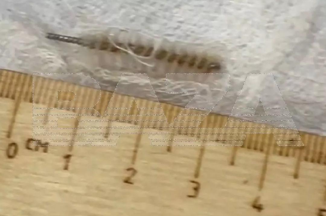 &Ouml;zel klinikte skandal ihmal! Doktor rahimde metal fır&ccedil;a unuttu 3