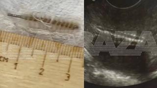 Özel klinikte skandal ihmal! Doktor rahimde metal fırça unuttu