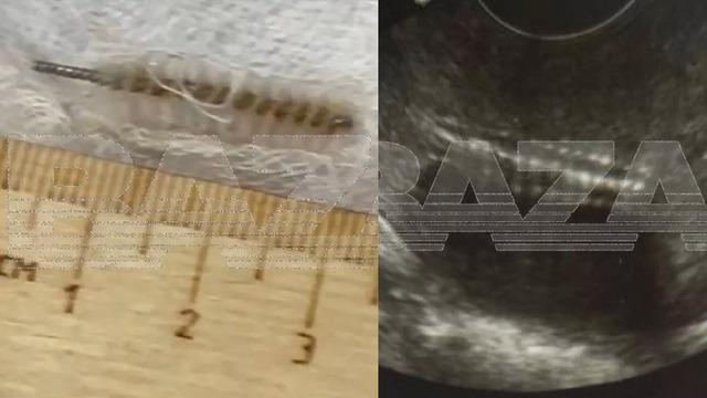 Özel klinikte skandal ihmal! Doktor rahimde metal fırça unuttu