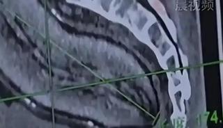 Doktorlar da inanamadı: Makatına &ccedil;ıktı! Tam 17 santim