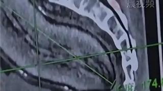 Doktorlar gözlerine inanamadı! Makatından 17 santimlik patates çıktı