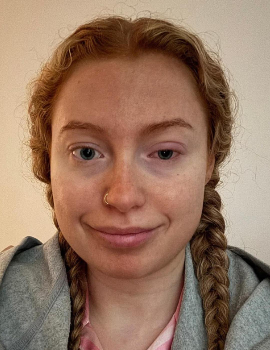 Tatile T&uuml;rkiye ye geldi, kabusu yaşadı! G&ouml;z kapağının derinine ka&ccedil;mış: 10 g&uuml;n sonra ortaya &ccedil;ıktı 1