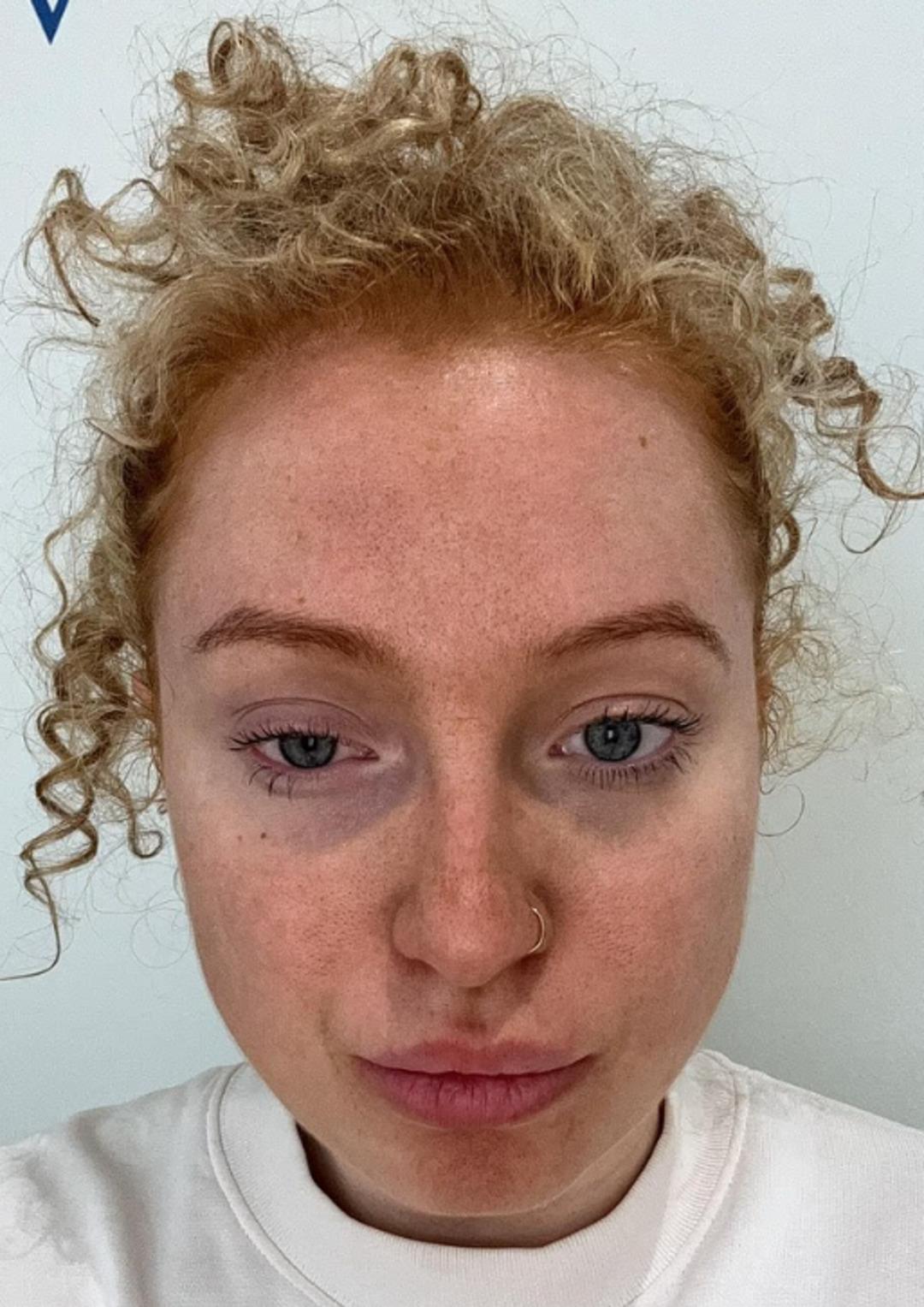 Tatile T&uuml;rkiye ye geldi, kabusu yaşadı! G&ouml;z kapağının derinine ka&ccedil;mış: 10 g&uuml;n sonra ortaya &ccedil;ıktı 2