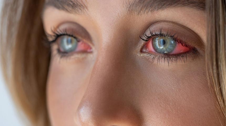 Tatile T&uuml;rkiye'ye geldi, kabusu yaşadı! G&ouml;z kapağının derinine ka&ccedil;mış: 10 g&uuml;n sonra ortaya &ccedil;ıktı