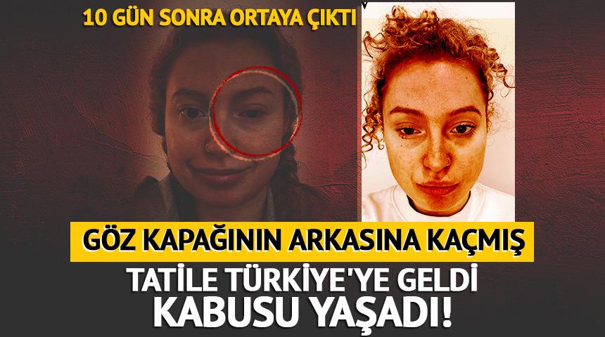 Tatile T&uuml;rkiye'ye geldi, kabusu yaşadı! G&ouml;z kapağının derinine ka&ccedil;mış: 10 g&uuml;n sonra ortaya &ccedil;ıktı
