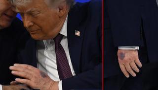 Trump'ın elindeki morluğun nedeni belli oldu