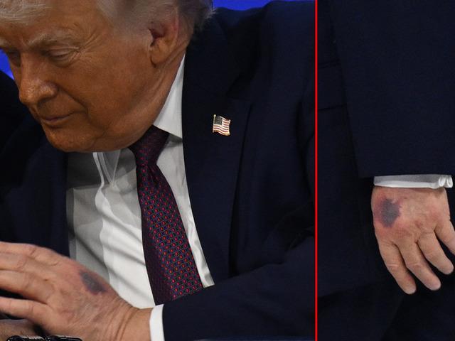 Trump'ın elindeki morluğun nedeni belli oldu