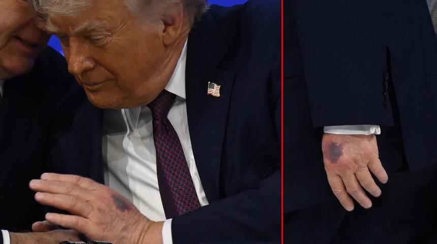 Trump&rsquo;ın morarmış eli g&uuml;ndem olmuştu: Beyaz Saray&rsquo;dan ve Trump&rsquo;tan a&ccedil;ıklama