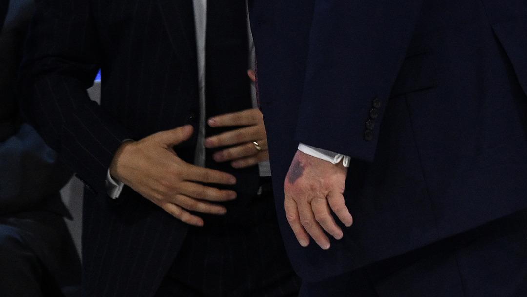 Trump&rsquo;ın morarmış eli g&uuml;ndem olmuştu: Beyaz Saray&rsquo;dan ve Trump&rsquo;tan a&ccedil;ıklama 1