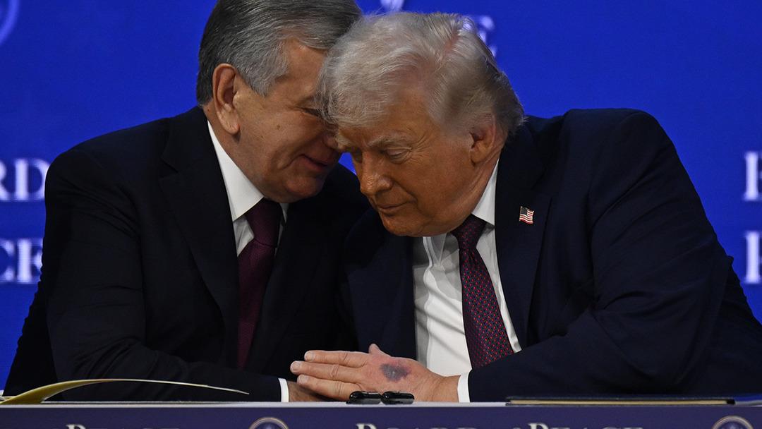 Trump&rsquo;ın morarmış eli g&uuml;ndem olmuştu: Beyaz Saray&rsquo;dan ve Trump&rsquo;tan a&ccedil;ıklama 2