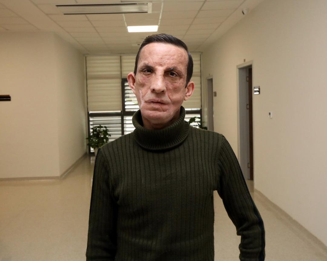 14 yıldır aynaya başka bir y&uuml;zle bakıyor! Yaşı bile o g&uuml;n değişti 2