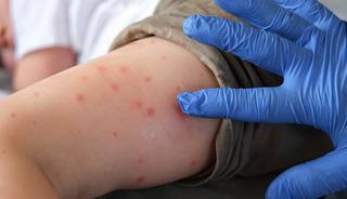 Uzman doktor "İlk defa b&ouml;yle bir sıklık g&ouml;r&uuml;yoruz" diyerek uyardı!