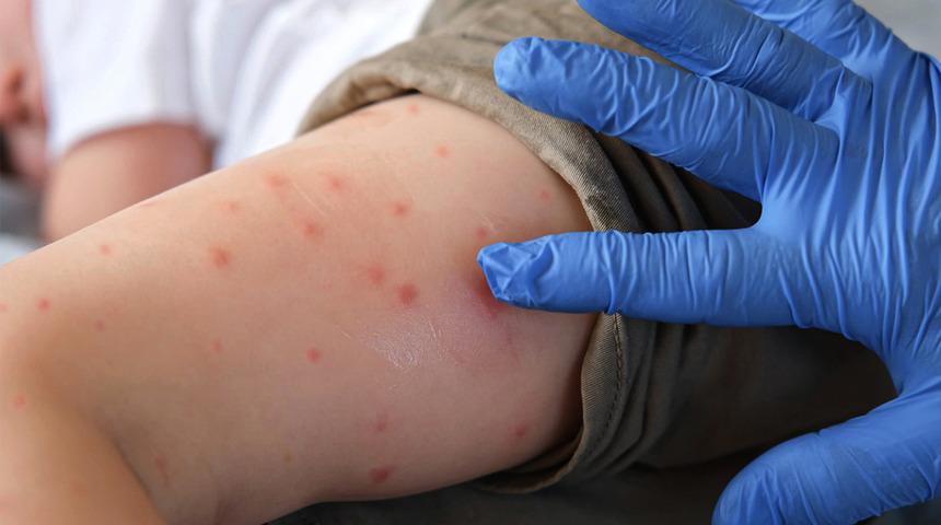 Polikliniklerde alarm! Uzman doktor "İlk defa b&ouml;yle bir sıklık g&ouml;r&uuml;yoruz" diyerek uyardı!