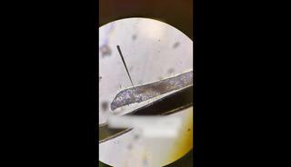 G&ouml;z&uuml;nde kaşıntı vardı, kirpik dibinde canlı yaşıyormuş!