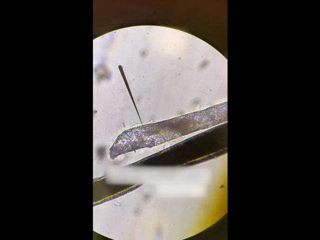 G&ouml;z&uuml;nde kaşıntı vardı, kirpik dibinde canlı yaşıyormuş!