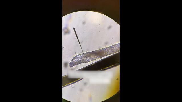 Gözünde kaşıntı şikayetiyle doktora gitti: Kirpik dibinde canlı yaşıyormuş!