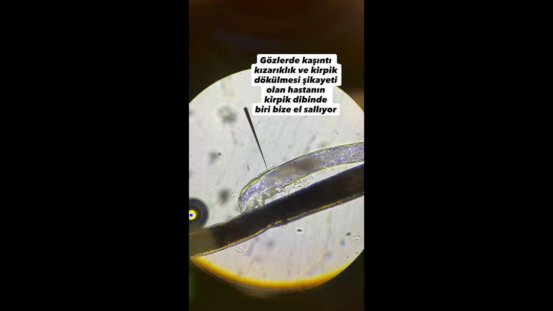 G&ouml;z&uuml;nde kaşıntı şikayetiyle doktora gitti: Kirpik dibinde canlı yaşıyormuş! 1