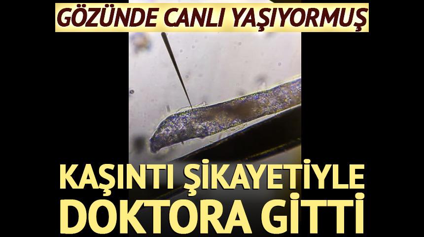 G&ouml;z&uuml;nde kaşıntı vardı, kirpik dibinde canlı yaşıyormuş!