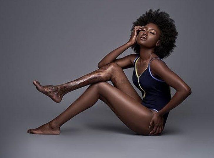 Ноги стали черными. Модель девушка гаитянка. Синдром Клиппеля-Треноне. Клиппель Треноне Вебера.