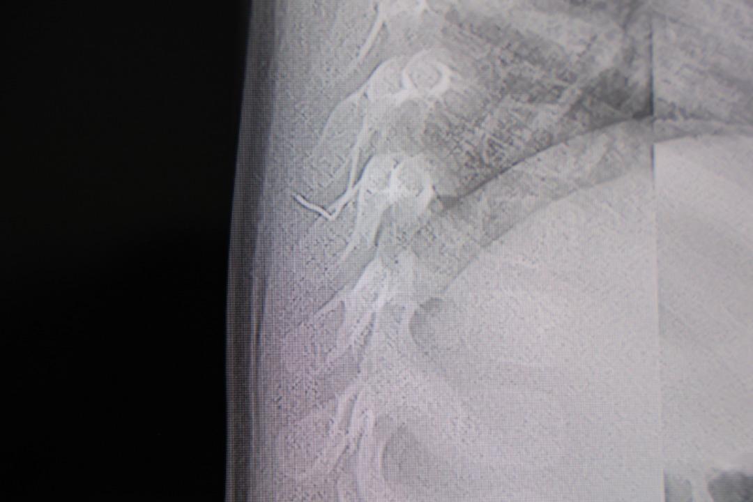 1 yaşındaki bebeğin sırtından 2 santimlik metal tel &ccedil;ıktı!  1