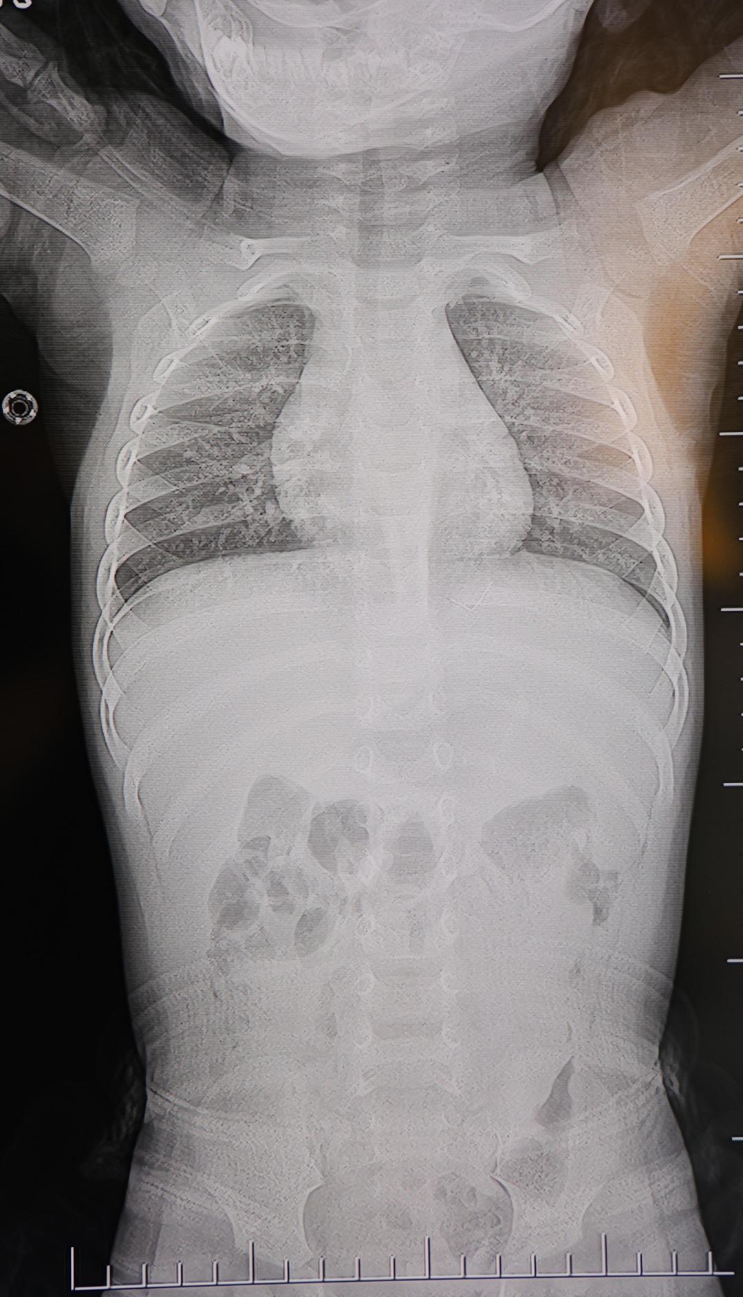 1 yaşındaki bebeğin sırtından 2 santimlik metal tel &ccedil;ıktı!  3