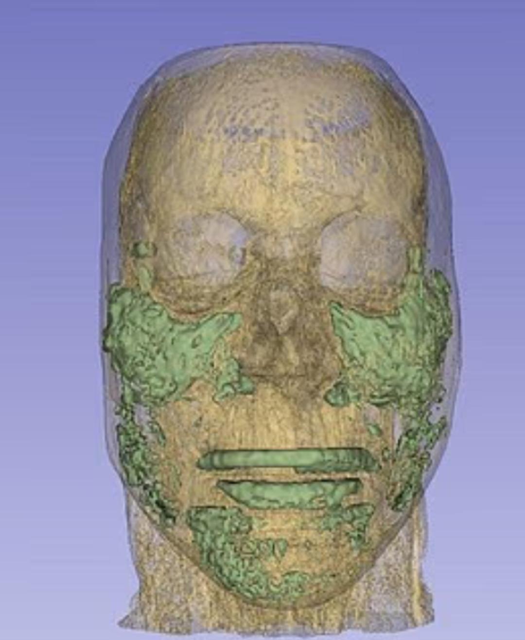 20 yıl boyunca suratının altında kalmış! Erimesini beklediği dolgular şişip t&uuml;m y&uuml;z&uuml;n&uuml; kaplamış 2