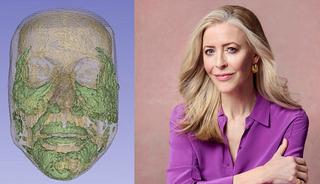 Erimesini beklediği dolgular şişip t&uuml;m y&uuml;z&uuml;n&uuml; kaplamış