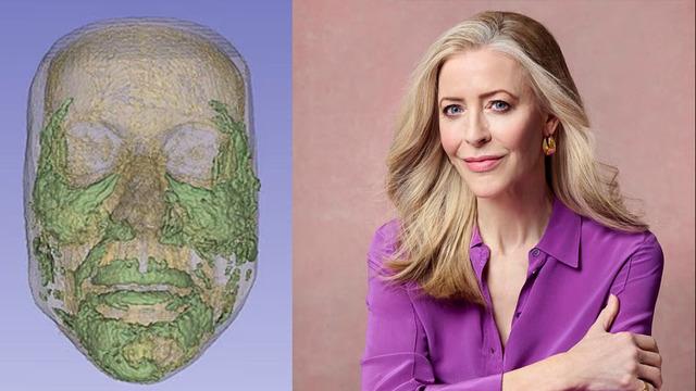 20 yıl boyunca suratının altında kalmış! Erimesini beklediği dolgular şişip tüm yüzünü kaplamış