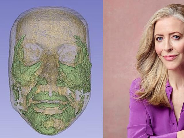 Erimesini beklediği dolgular şişip t&uuml;m y&uuml;z&uuml;n&uuml; kaplamış