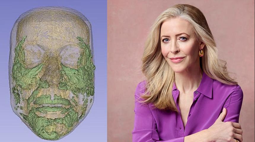 20 yıl boyunca suratının altında kalmış! Erimesini beklediği dolgular şişip t&uuml;m y&uuml;z&uuml;n&uuml; kaplamış