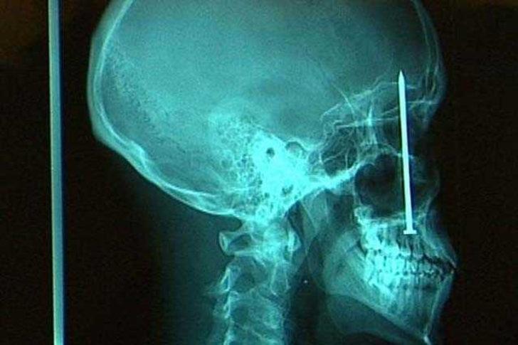 İnsanların vücudundan çıkan garip nesneler  G1